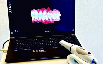 Impronta dentale digitale con scanner intraorale